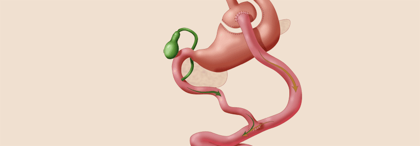 Gastric Sleeve Turkey: Comparing Costs, Packages, and Surgeon Expertise